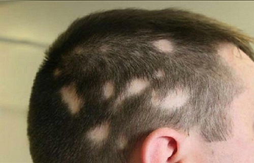 روش های درمان ریزش موی سکه ای 