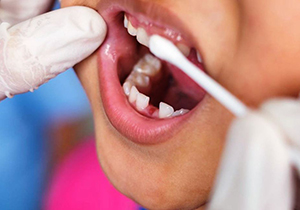 کاهش احتمال ایجاد پوسیدگی دندان دانش آموزان ارسنجانی