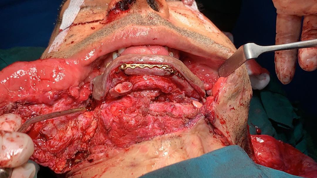 جراحی صورت مردی که به طرز وحشیانه‌ای مورد هدف گلوله قرار گرفت + تصاویر (۱۸+)