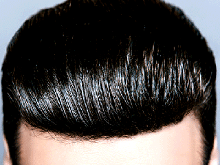 پروتز مو و هر آنچه باید درباره آن بدانید