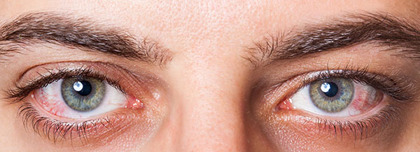 علت خشکی چشم چیست؟ + راهکارهای درمان آن