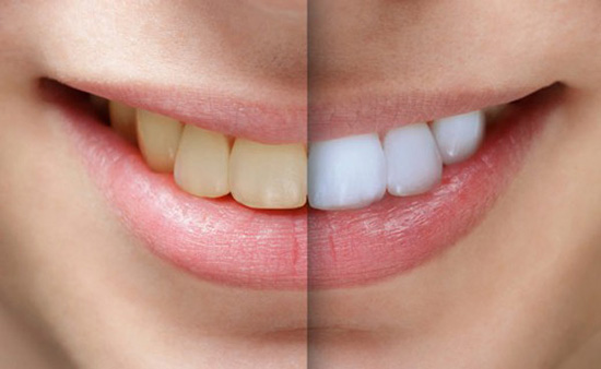 از تزریق ژل تا سفید کردن دندان در آرایشگاه ها/ نابینایی و از بین رفتن لب با بوتاکس در سالن های زیبایی+ تصاویر