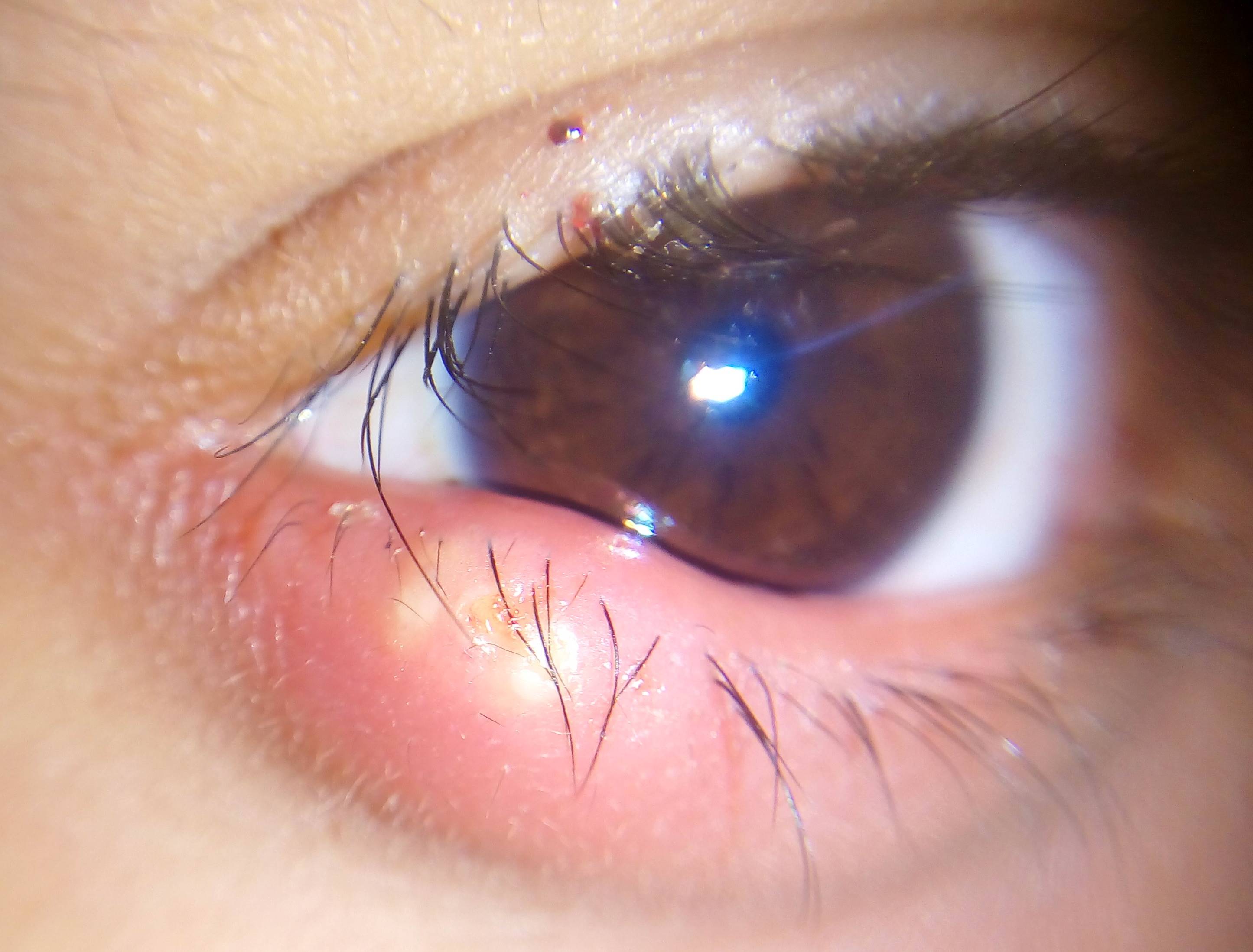 شایعترین بیماری‌های چشمی را بشناسید.