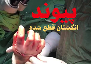 پیوند دست قطع شده در شیراز