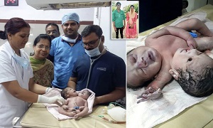 تولد نوزاد دو سر در هندوستان!