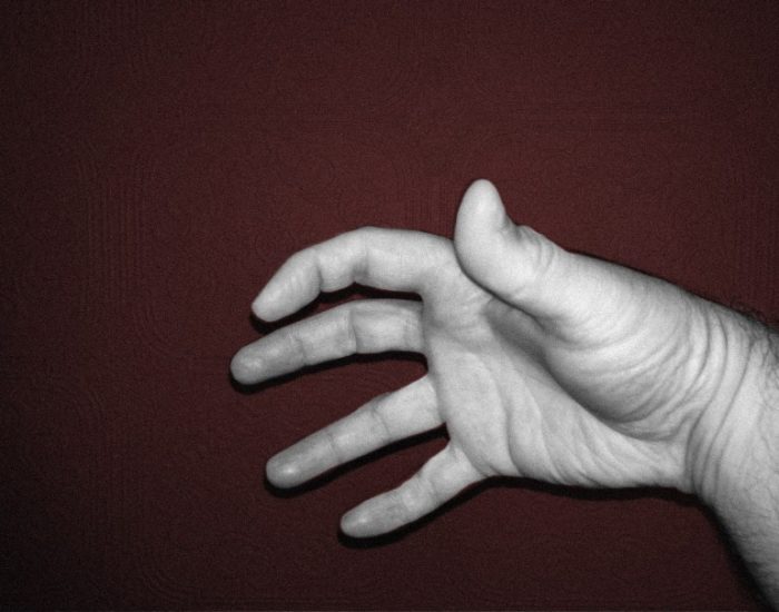 سندرم دست بیقرار با سندرم دست بیگانه چه تفاوتی دارد؟