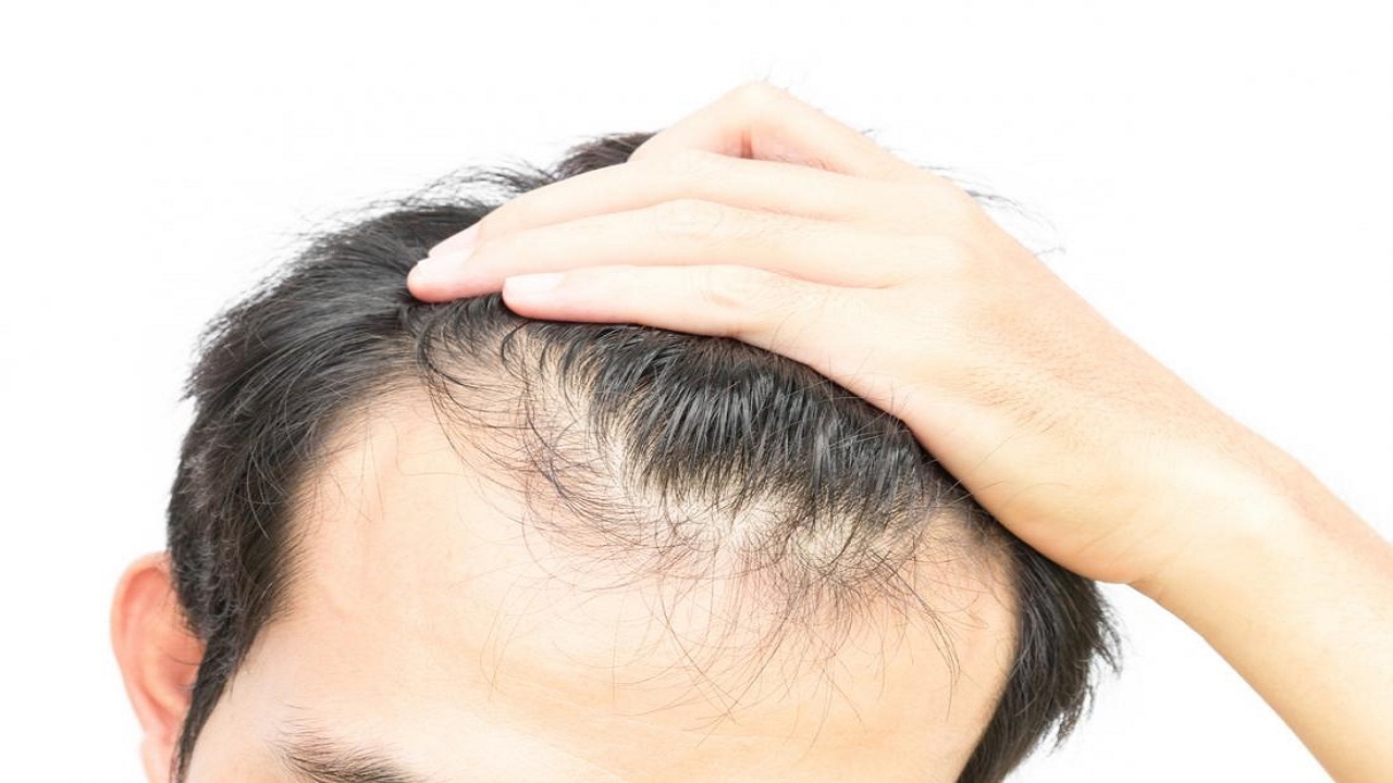 ۴ درمان خانگی برای کنترل چربی موی سر