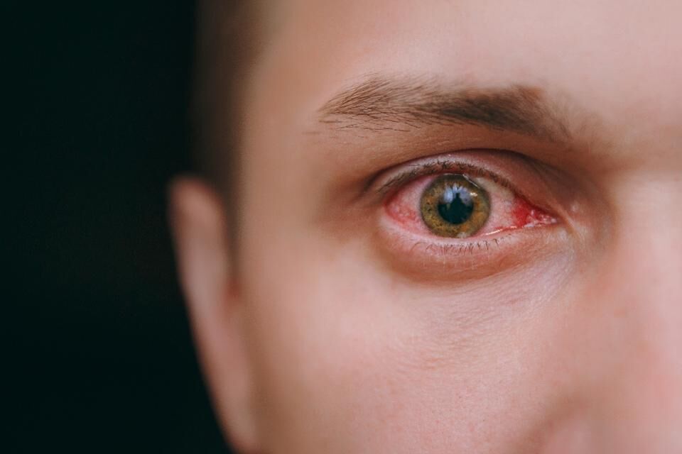 مجله سلامت متخصص چشم پزشکی فوق تخصص قرنیه عوامل آلرژی سلامت چشم‌ انواع آلرژی
