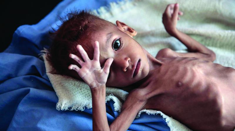 سوء تغذیه کودکان و پیامد‌های اسفناک آن؛ چه باید کرد؟