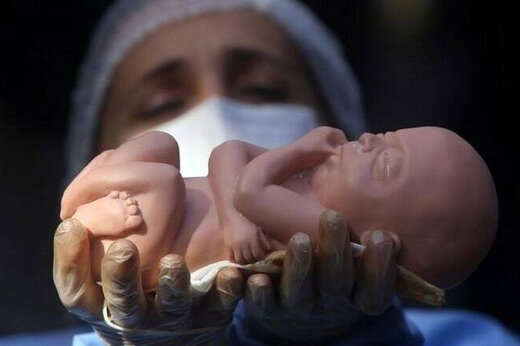 سقط جنین زیرزمینی