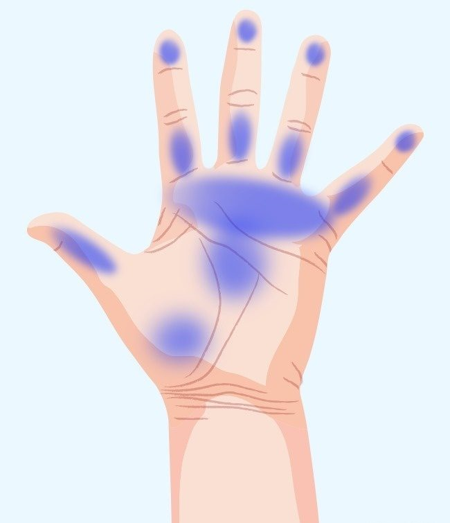 سوزن سوزن شدن دست‌ها؛ ۷ تهدید مهم برای سلامت