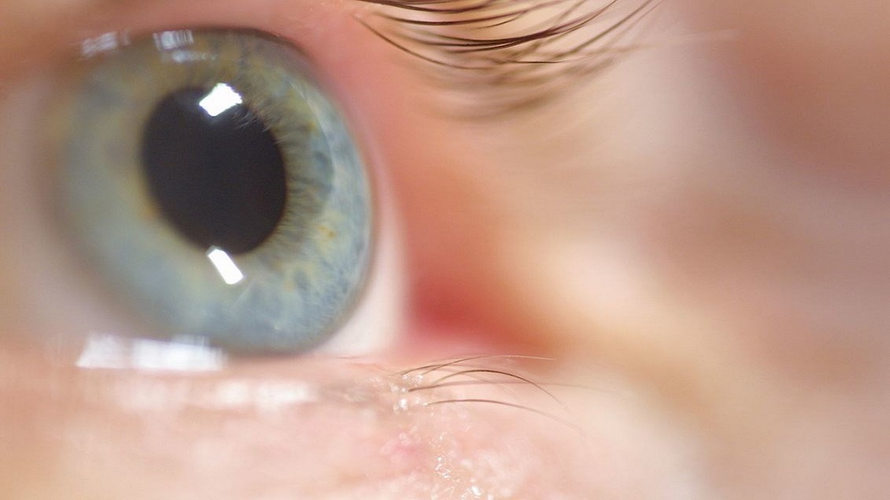 بیماری چشمی که براثر ابتلا به عفونت ها در دوران بارداری جنین را در گیر می کند