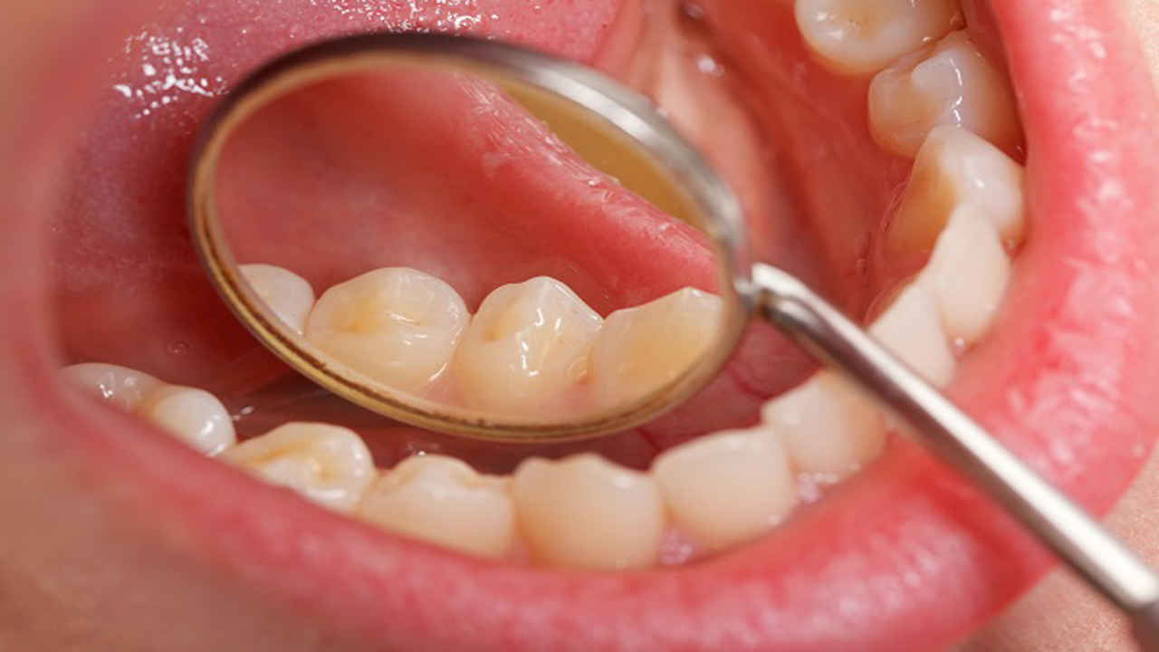 سرطان‌های دهان، جزو ۱۰ سرطان شایع بدن
