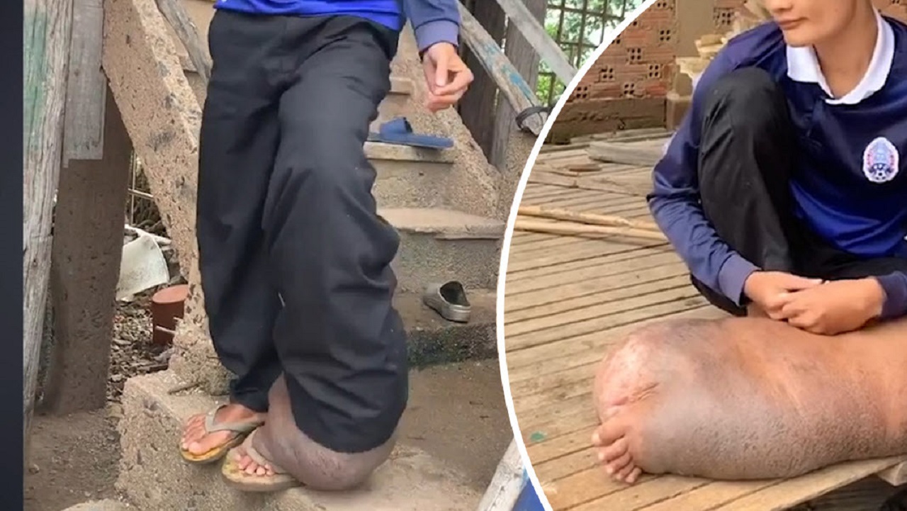 وضعیت عجیب پای پسر کامبوجی پس از گزش پشه!