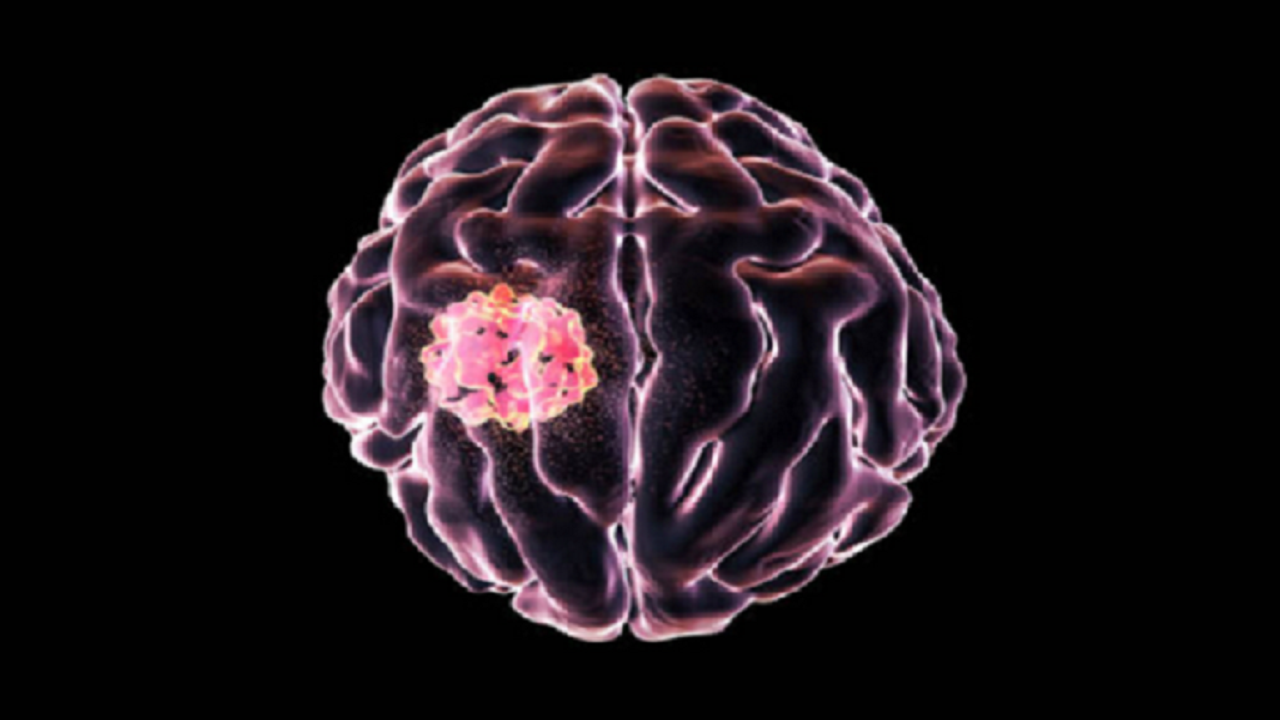 چگونه ابتلای خود به تومور مغزی را تشخیص دهیم؟