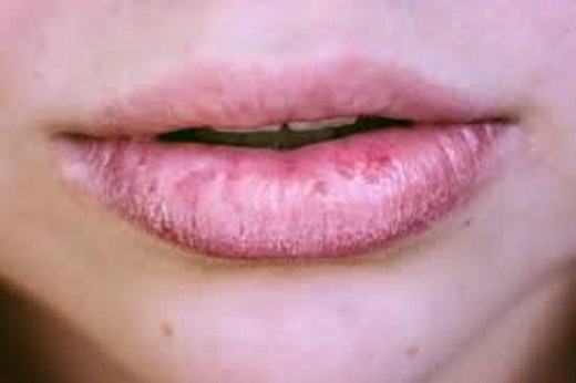 ترک گوشه‌های لب نشانه یک مشکل عفونیاین نوع عفونت می‌تواند به زبان، گونه ها، سقف دهان، لثه ها، لوزه‌ها و یا پشت گلو گسترش یابد. مطالعات نشان می‌دهد که برفک دهانی در افراد مسن به دلیل کاهش ایمنی بیشتر دیده می‌شود.ترک خوردن گوشه‌های دهان یکی از مهمترین نشانه‌های عفونت قارچی است و علائم دیگری از برفک دهان نیز وجود دارد که باید به آن‌ها توجه کنید.وقتی به داخل دهان خود در آینه نگاه می‌کنید، ممکن است متوجه ضایعات سفید و شفاف و خامه‌ای شوید و این ضایعات برجسته می‌توانند کمی شبیه ظاهر پنیر کاتاژ باشند و در صورت مالش یا خراش ممکن است خونریزی کنند.ناحیه دهان نیز ممکن است قرمز و زخم بوده و این درد به حدی شدید باشد که هنگام خوردن و یا قورت دادن غذا مشکل ایجاد کند.برخی افراد در دهان خود احساس پنبه می‌کنند که این یکی دیگر از علائم عفونت است.برفک دهان را می‌توان توسط پزشک یا دندانپزشکی تشخیص داد که دهان شما را معاینه می‌کند. درمان نیز معمولاً شامل نسخه‌ای از دارو‌های ضد قارچ است، اما یک سری اقدامات احتیاطی وجود دارد که می‌توانید در وهله نخست برای جلوگیری از عفونت انجام دهید:مسواک زدن حداقل دو بار در روز و نخ دندان کشیدن روزانهمسواک را با افراد دیگر به اشتراک نگذارید و مسواک خود را به طور مرتب تعویض کنید.برای کسانی که از دندان مصنوعی استفاده می‌کنند، شب آن‌ها را برداشته و روزانه تمیز کنند.دهان خود را با آب نمک گرم غرغره کنید یا با دهان شویه دارویی بشویید.بیشتر بخوانید:انتهای پیام/