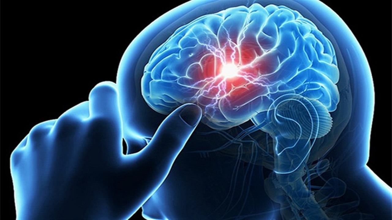 مهمترین علائم سکته حاد مغزی را بشناسید
