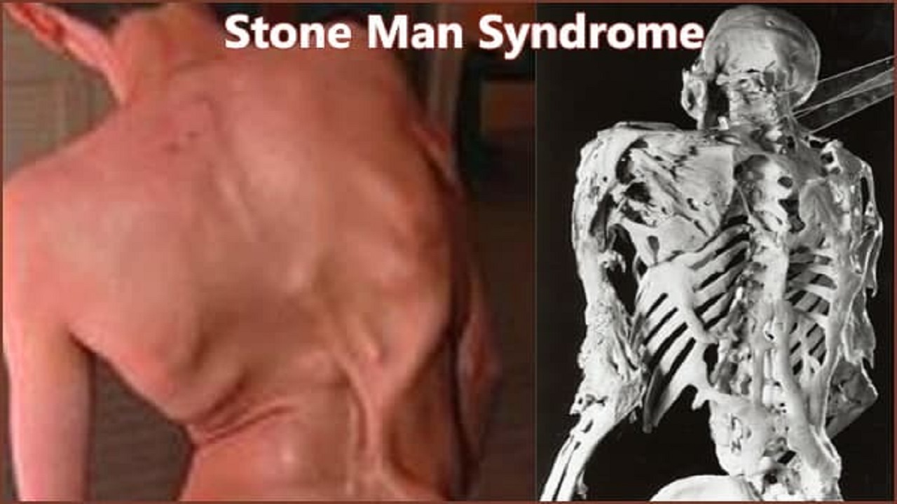 مرد سنگی، سندرمی بدون درمان