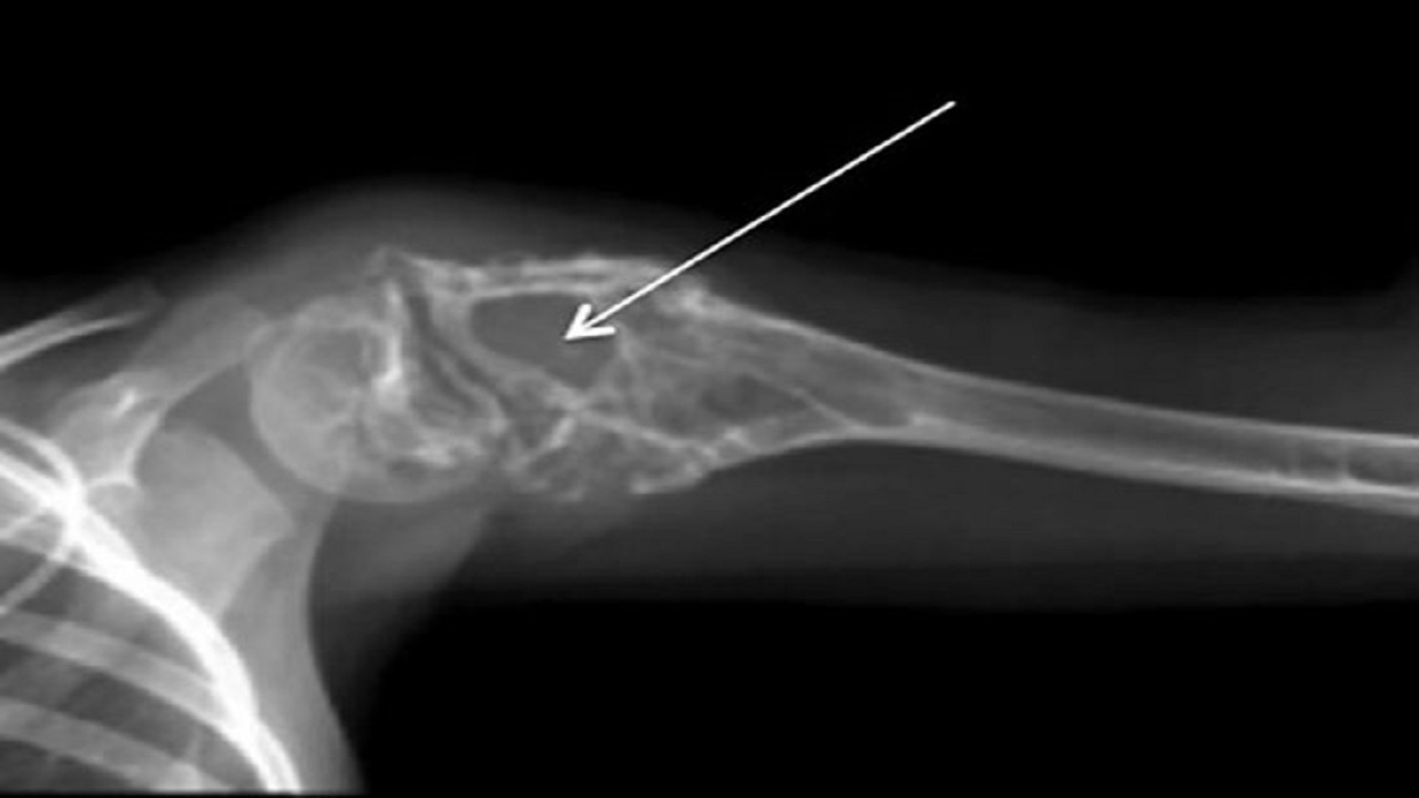 Диагноз саркома. Саркома Юинга опухоль костей. Остеосаркома кости рентген. Саркома Юинга плечевой кости.