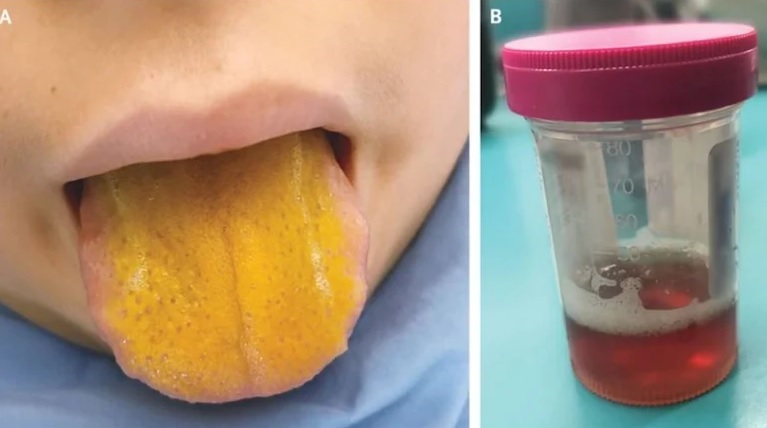 عجیب‌ترین سندرمی که باعث زرد رنگ شدن زبان بیمار می‌شود