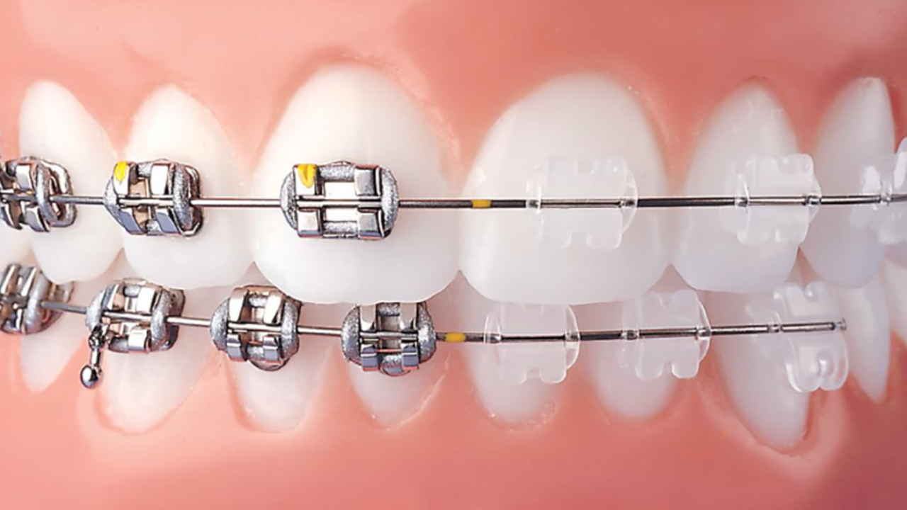 فیلمی از مراحل ارتودنسی دندان