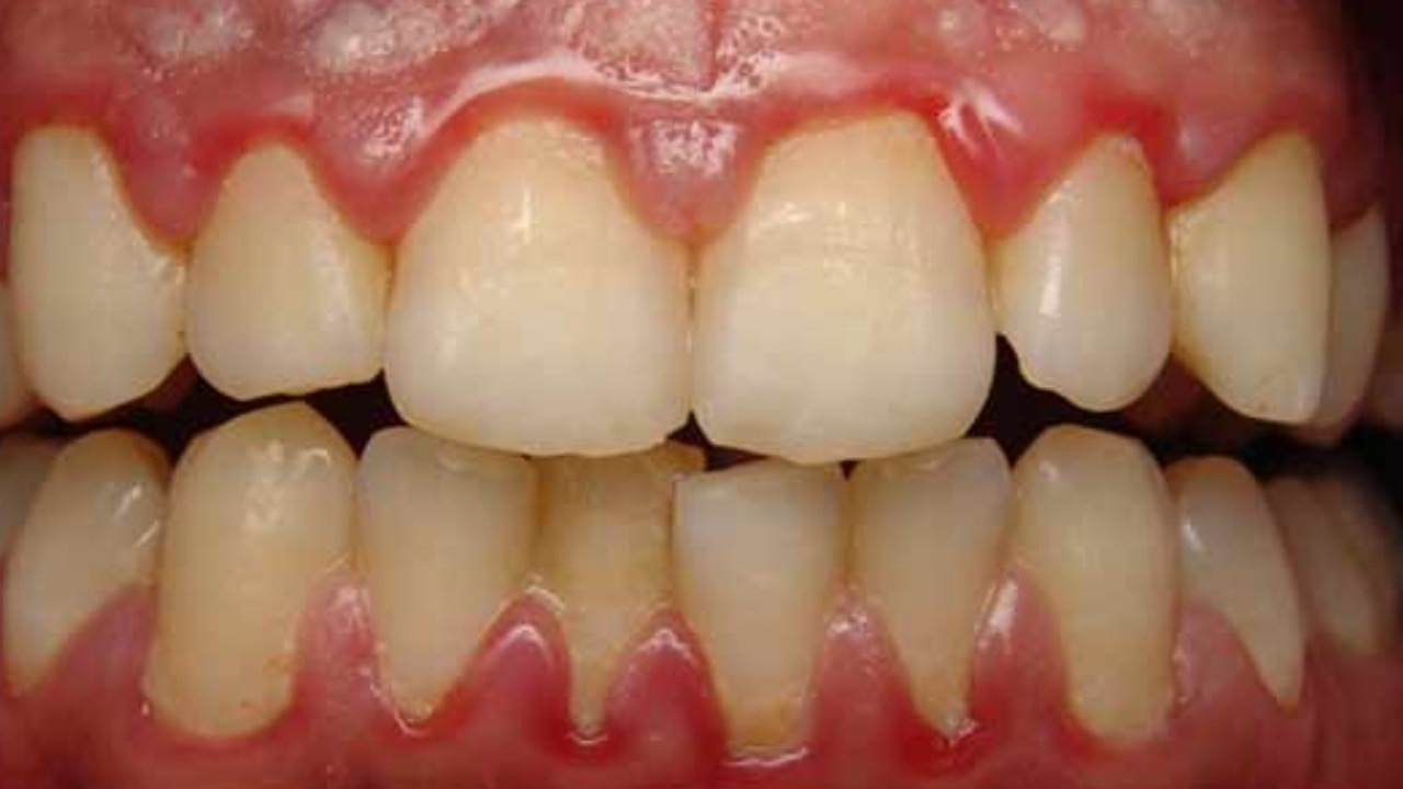 عدم رعایت بهداشت دهان و دندان مهمترین علت بیماری های لثه