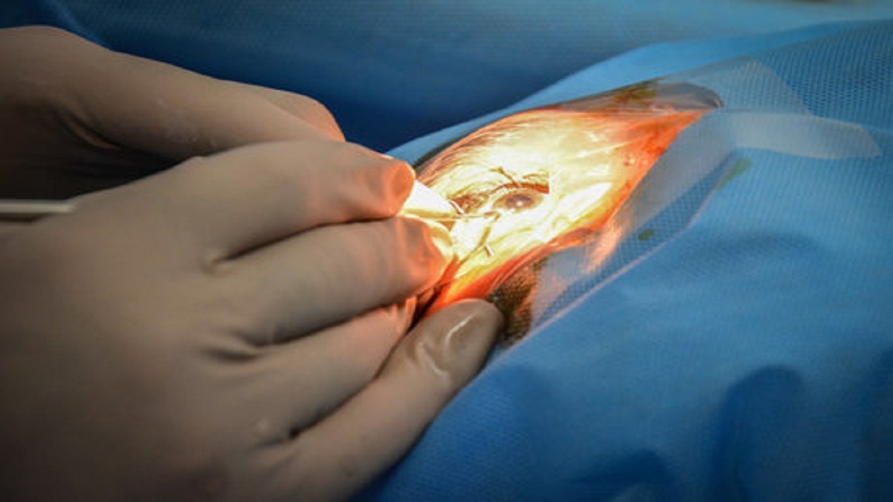 انجام ۲۵۰ عمل جراحی چشم رایگان در مناطق محروم دزفول