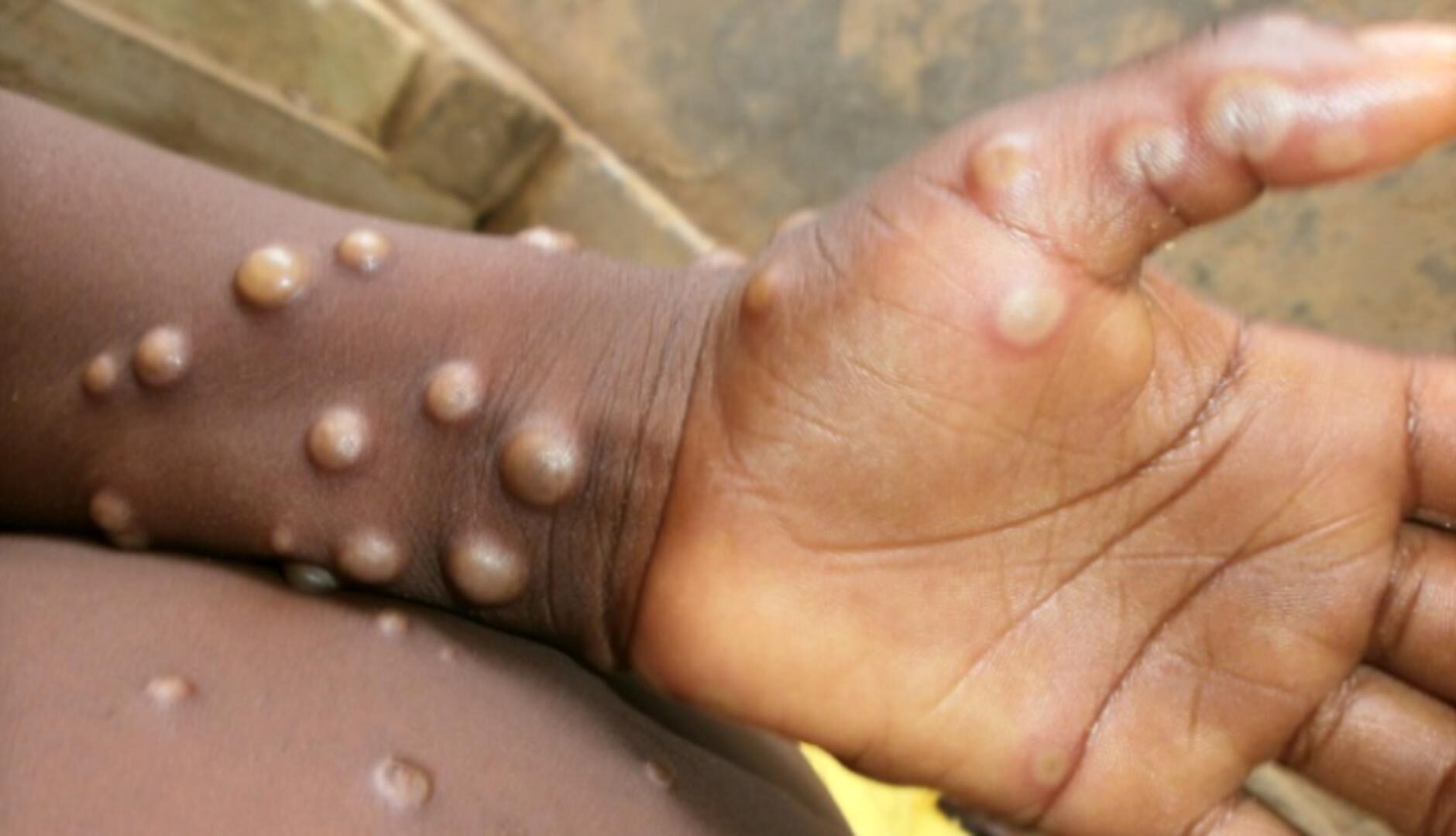 سازمان جهانی بهداشت: واکسیناسیون عمومی علیه آبله میمون نیاز نیست