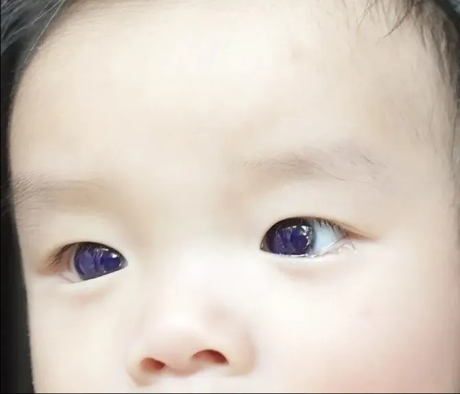 آبی شدن چشمان قهوه‌ای یک نوزاد پس از مصرف داروی کرونا