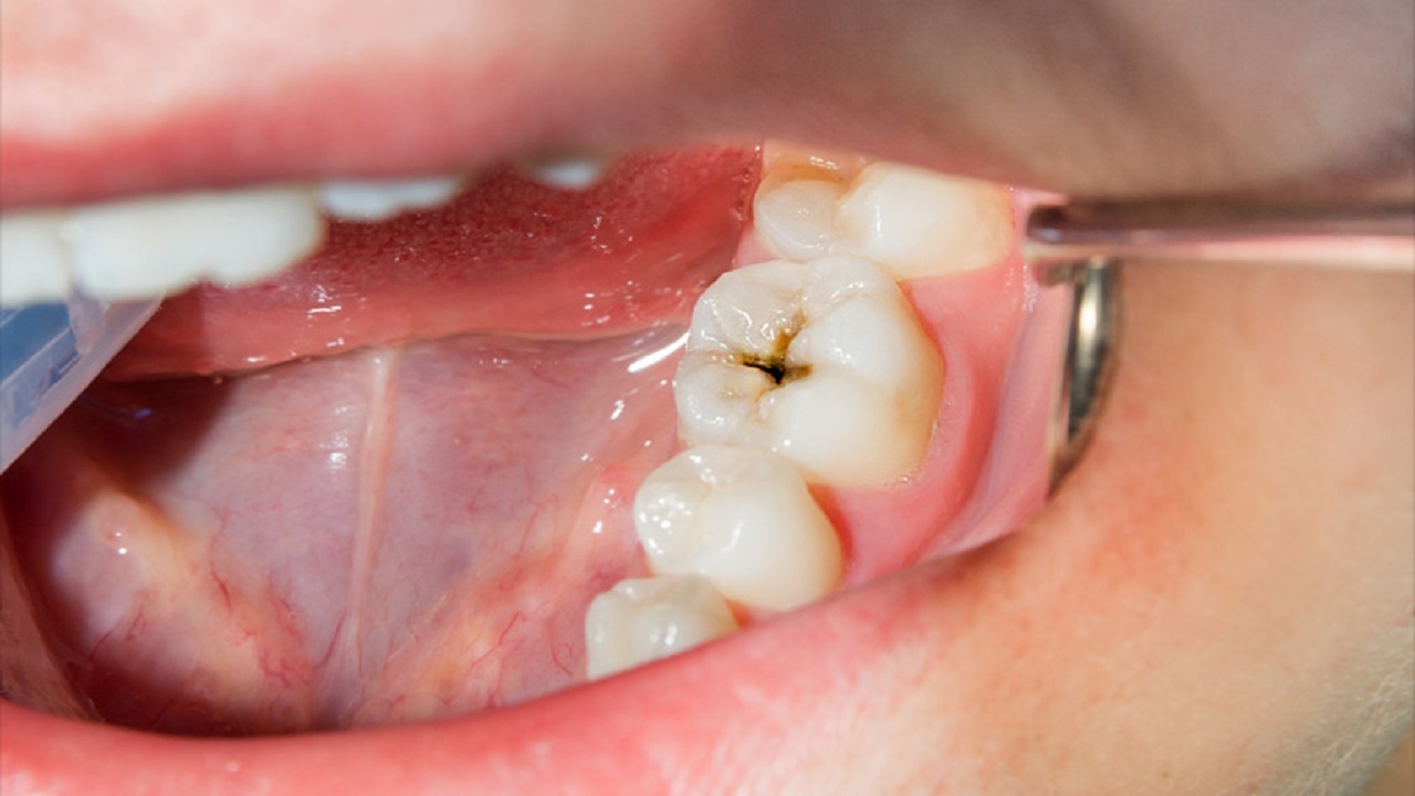 کدام مواد غذایی از پوسیدگی دندان‌ها پیشگیری می‌کنند؟