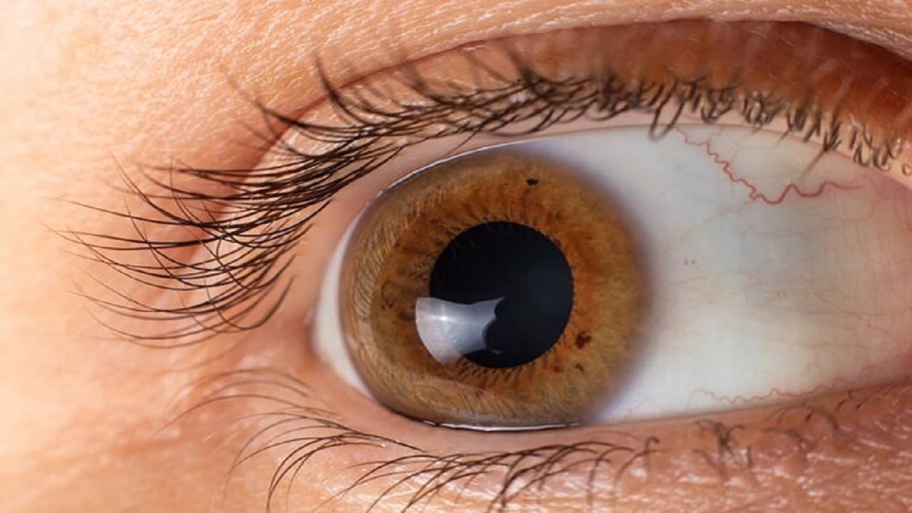 چشم ها چه بیماری هایی را اطلاع می دهند؟