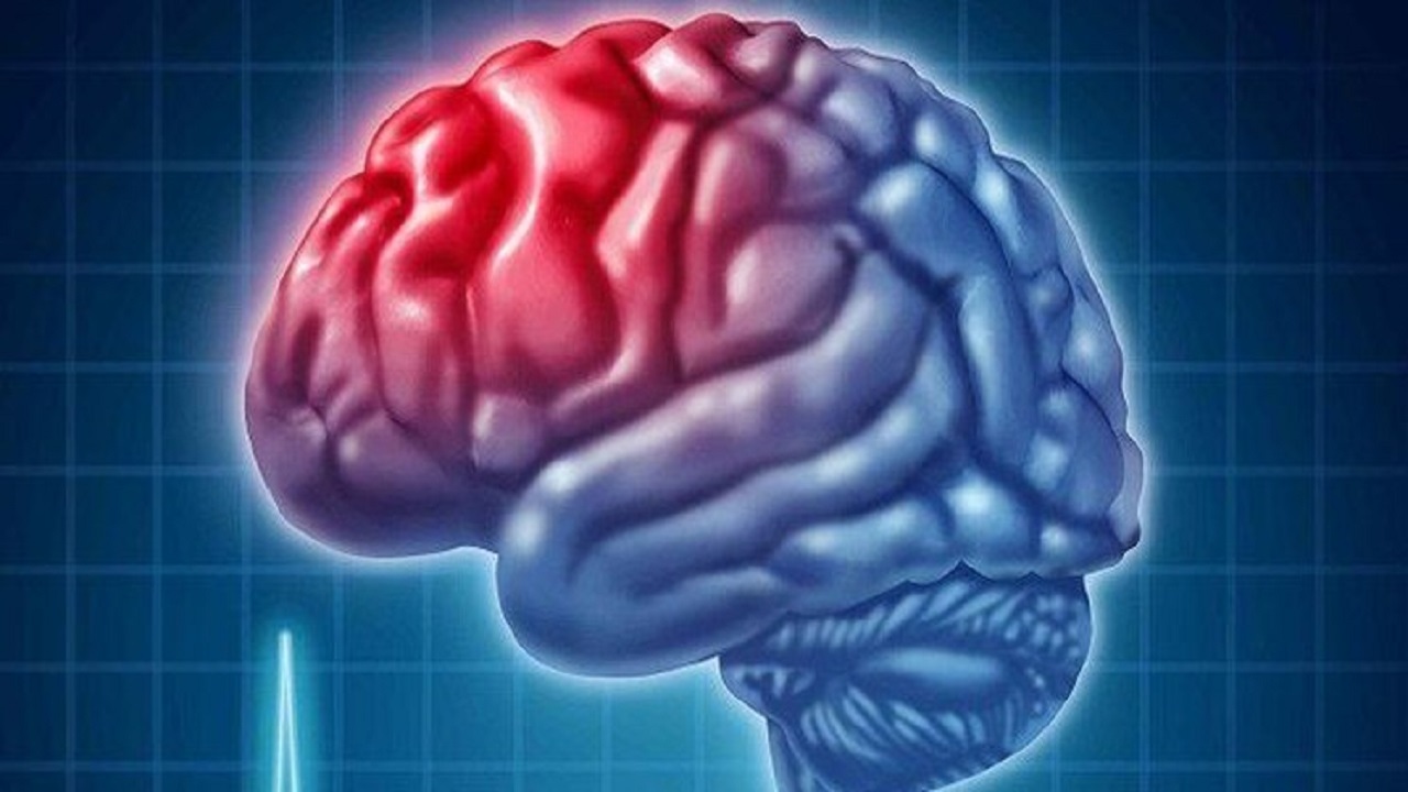 ۸۰ تا ۹۰ درصد سکته‌های مغزی قابل پیشگیری است