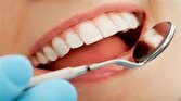 باشگاه خبرنگاران -۴۵ درصد از جمعیت جهان از پوسیدگی دندان رنج می‌برند