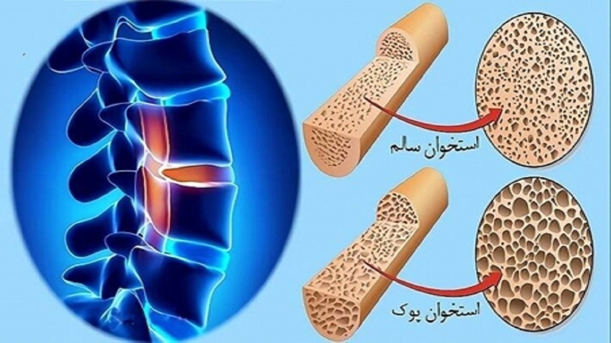 باشگاه خبرنگاران -استعمال دخانیات و مصرف کورتون سبب افزیش احتمال ابتلا به پوکی استخوان می‌شود