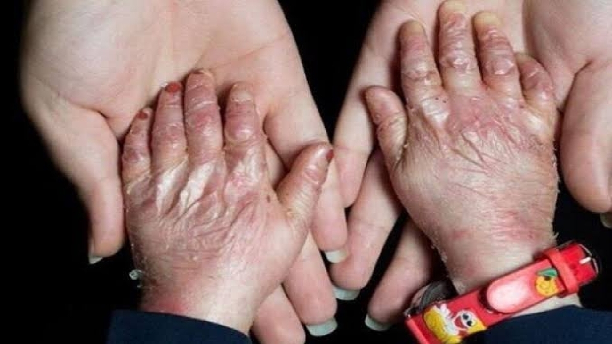 باشگاه خبرنگاران -افزایش شناسایی بیماری‌های نادر به دلیل پیشرفت پزشکی