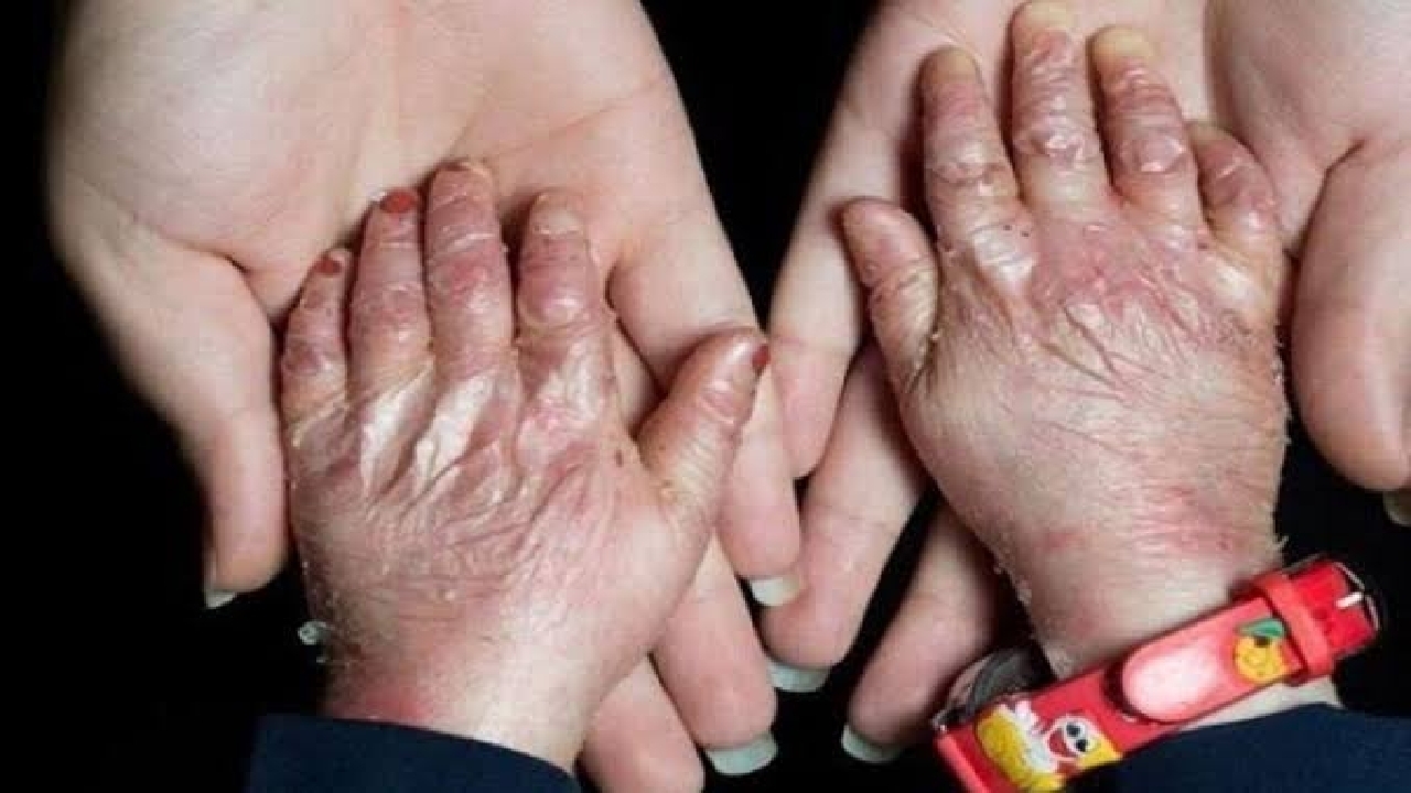 افزایش شناسایی بیماری‌های نادر به دلیل پیشرفت پزشکی